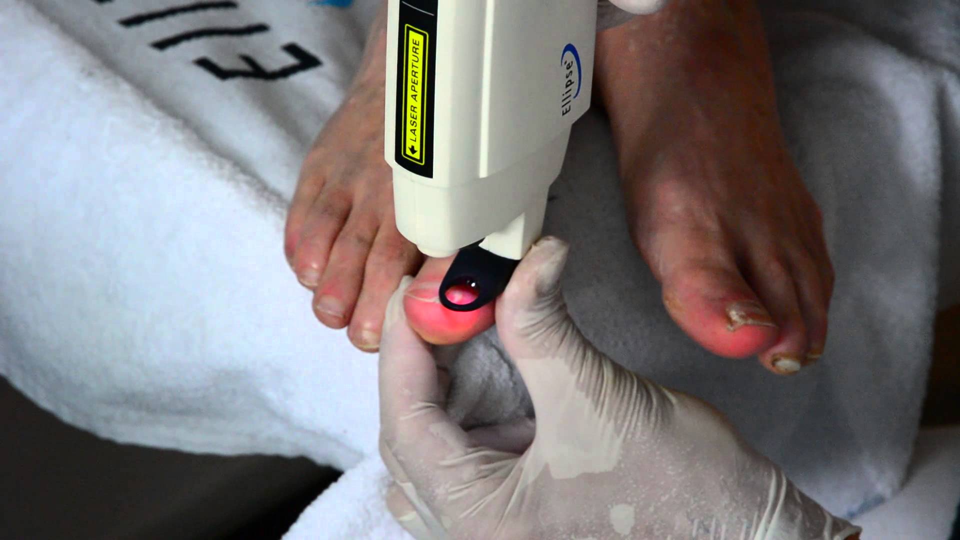 treatment of onychomycosis nail fungus