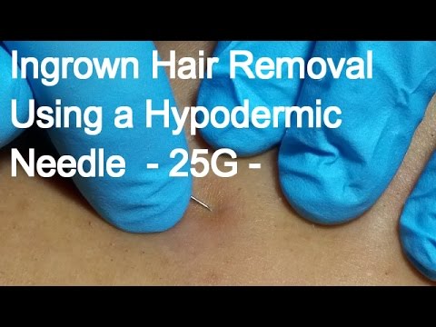 Ingrown Hair Removal Using A Hypodermic Needle 25g