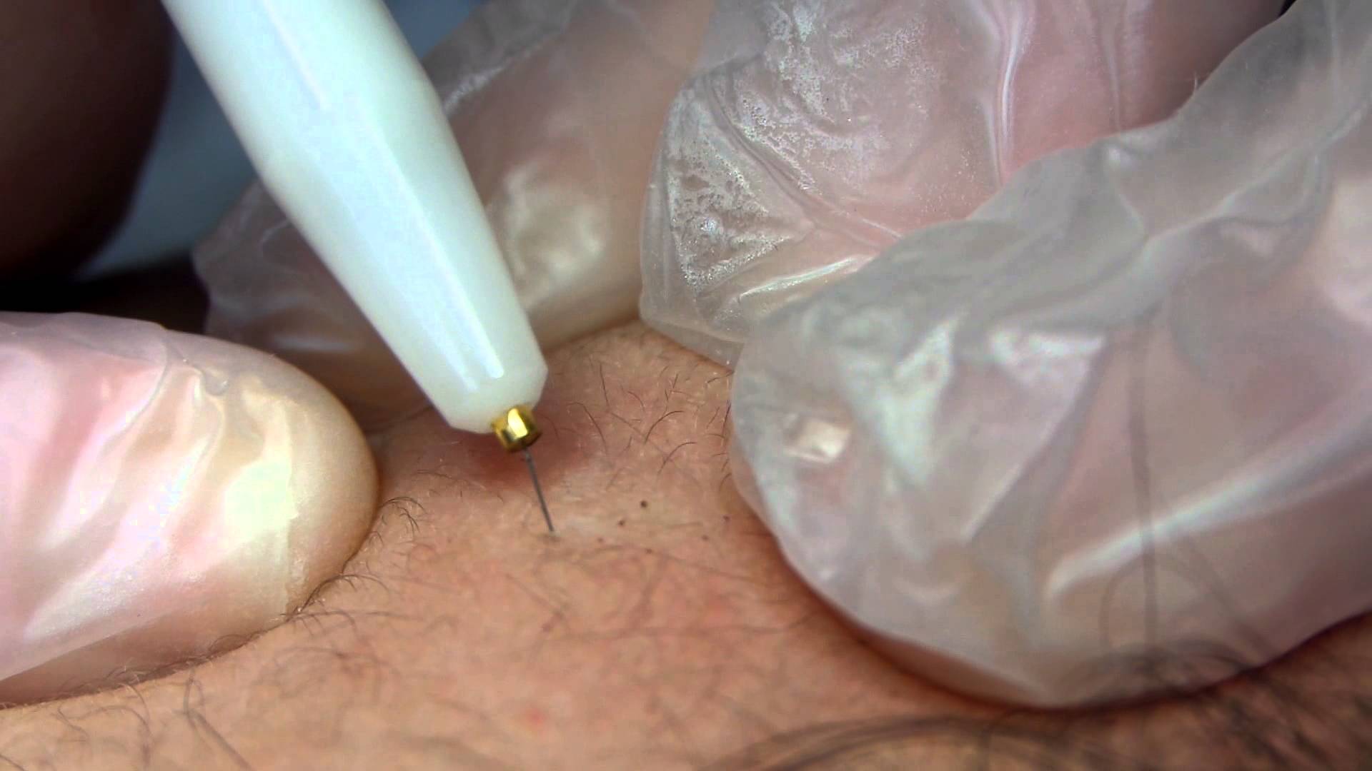 Electrolysis On Vellus Hair Female Face