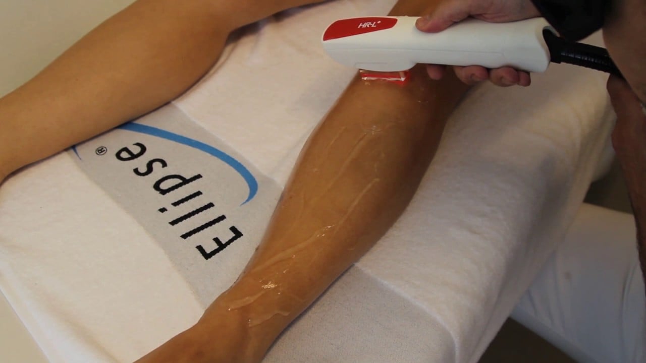 Copy Of Hair Removal In Bikini Line Underarm And Legs By Ellipse I2pl Laser